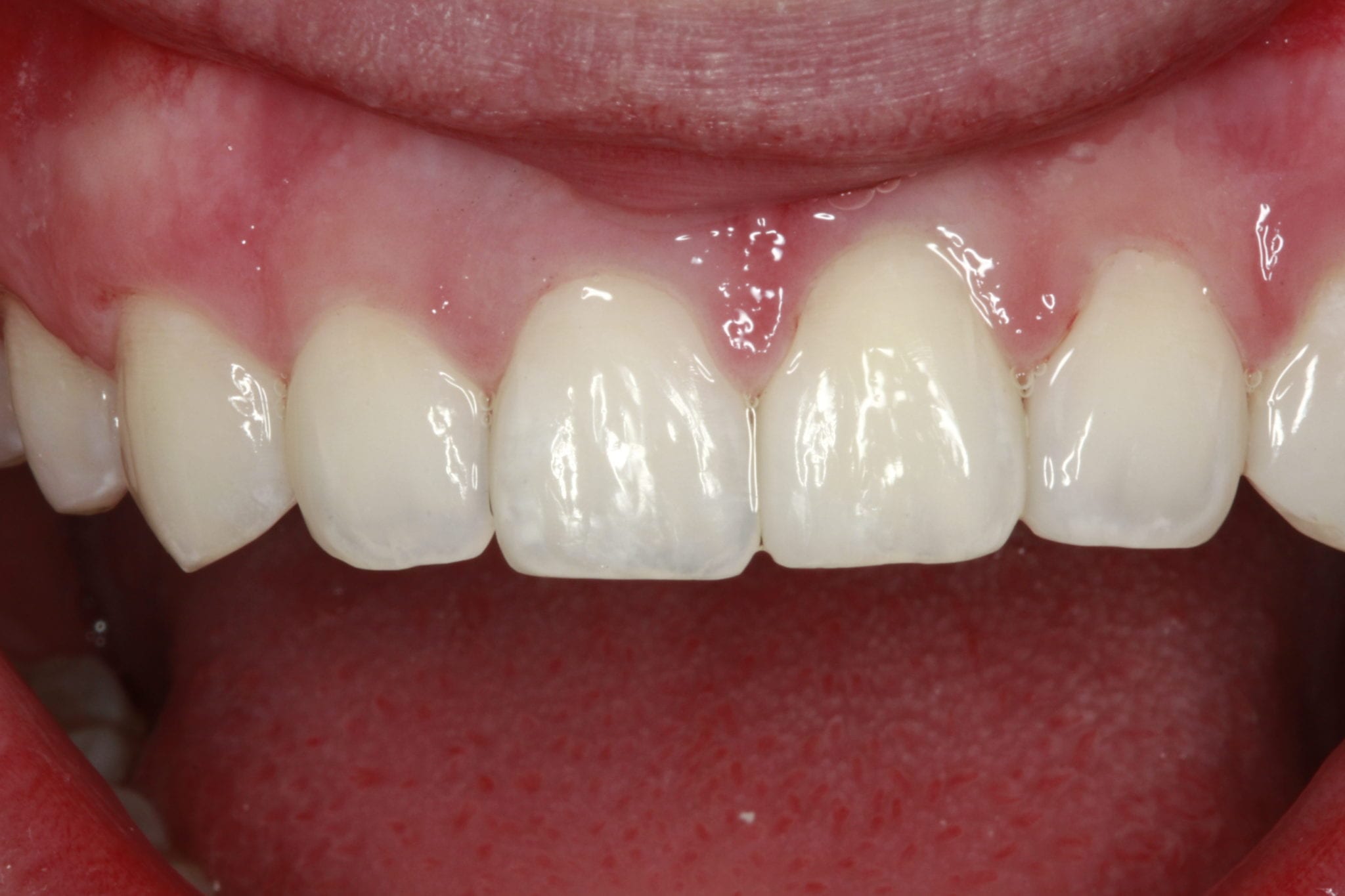 Closing Gaps Between Teeth With Bioclear After | Santa Ana, CA | Randy Fong DDS