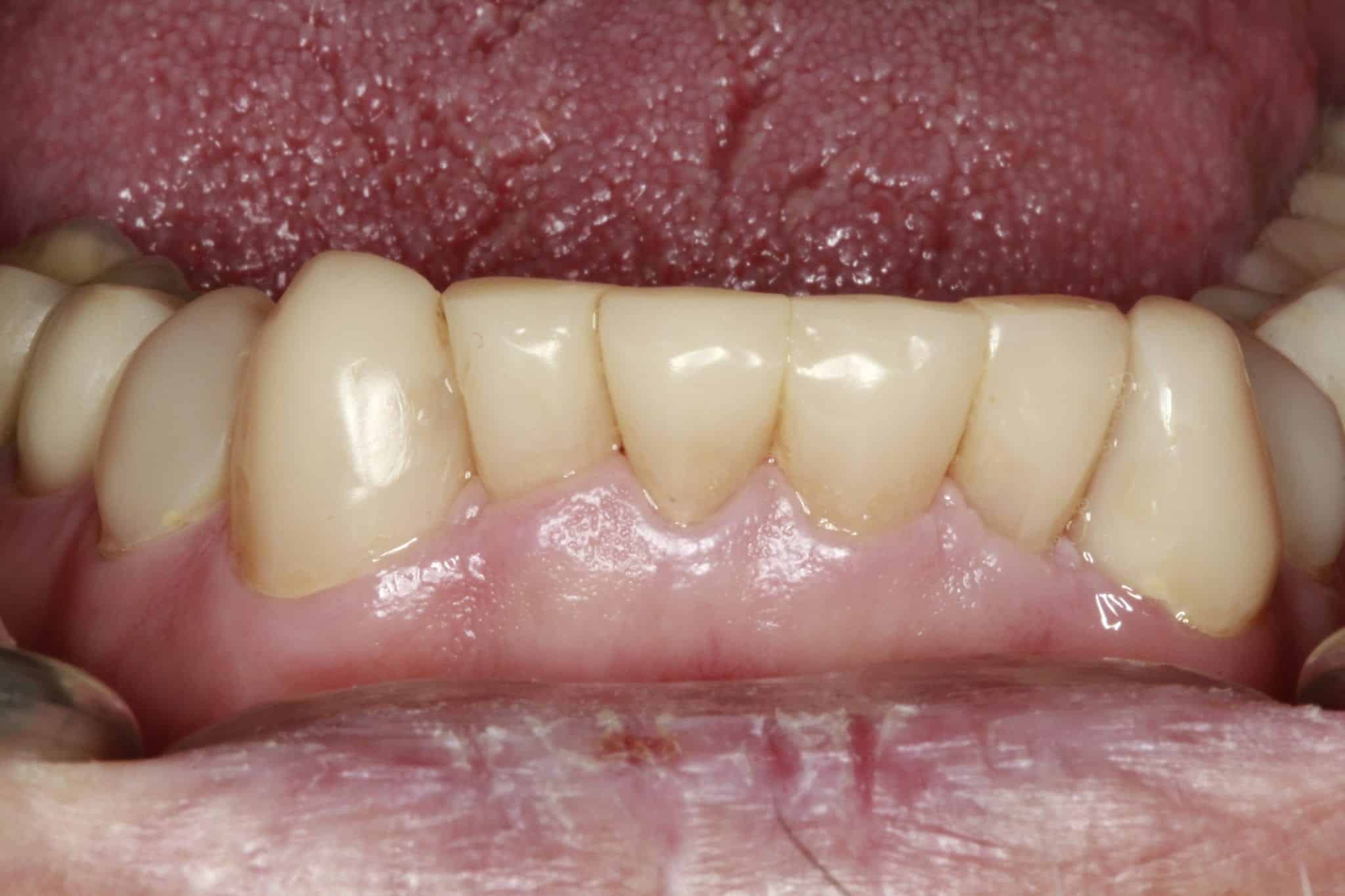 Bioclear Worn Teeth Regeneration After | Santa Ana, CA | Randy Fong DDS