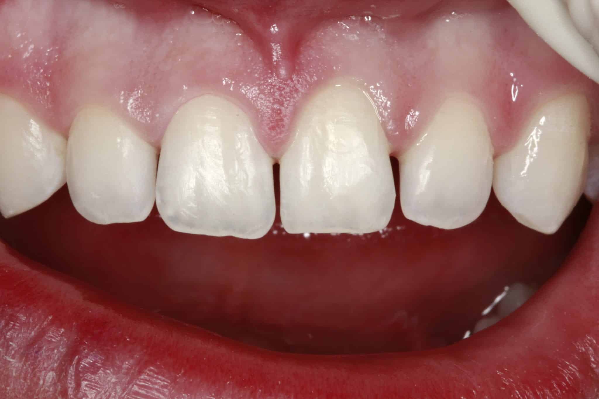 Closing Gaps Between Teeth With Bioclear Before | Santa Ana, CA | Randy Fong DDS