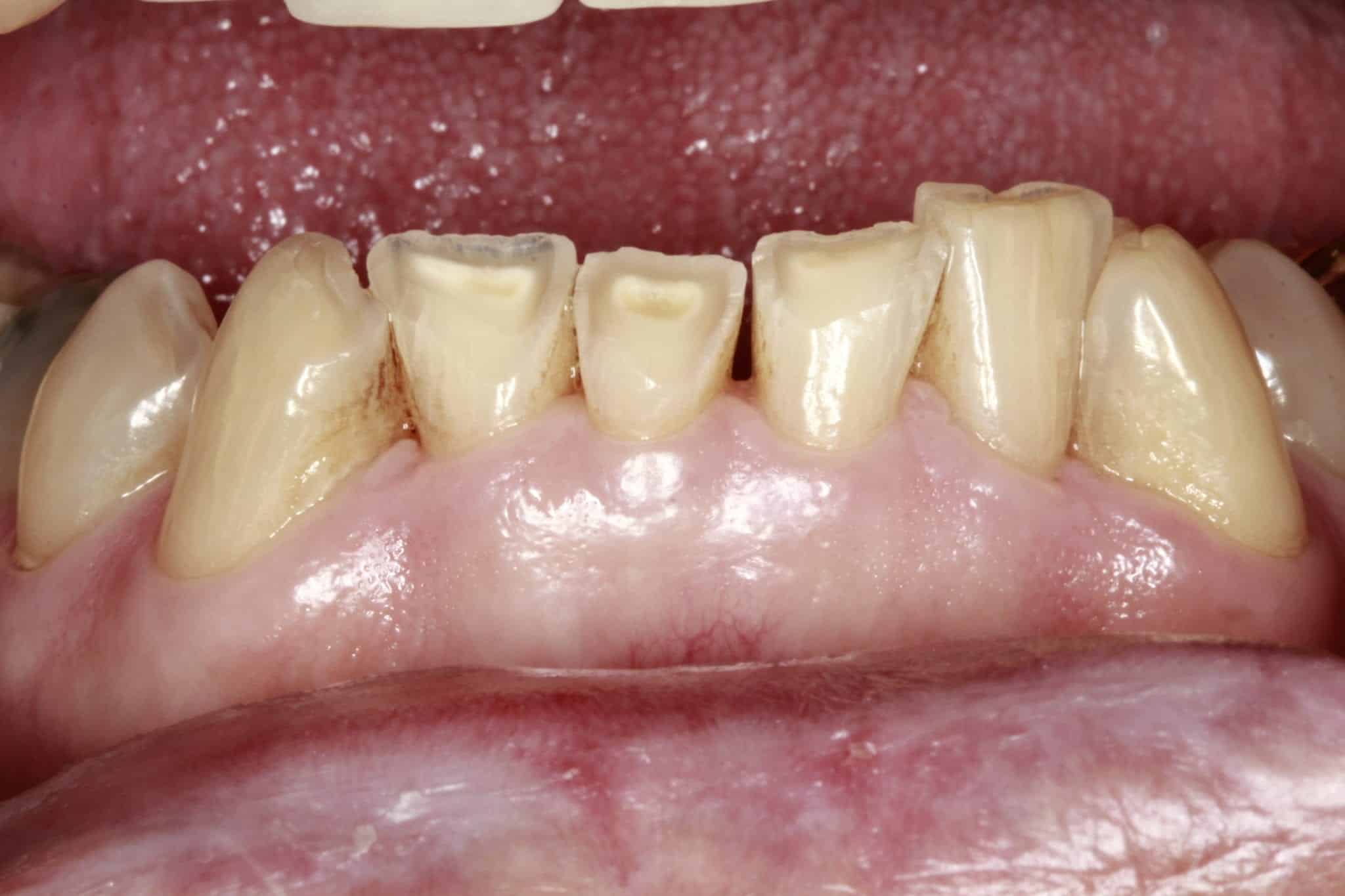 Bioclear Worn Teeth Regeneration Before | Santa Ana, CA | Randy Fong DDS