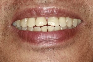 before image | bioclear | santa ana, ca