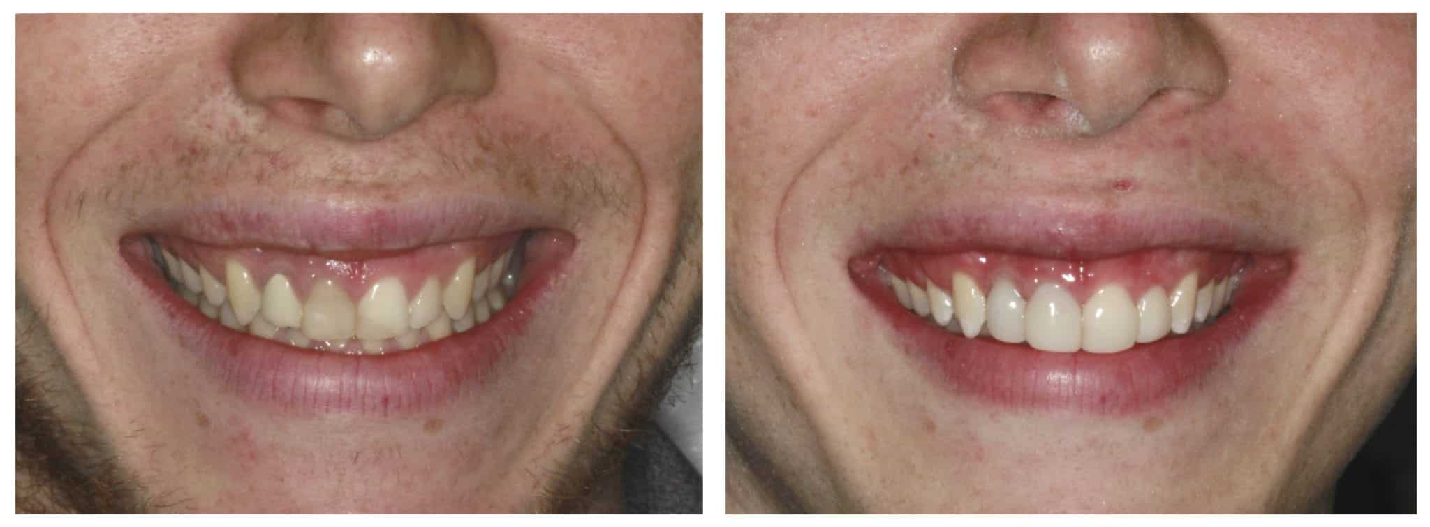 bioclear before and after photo | bioclear santa ana