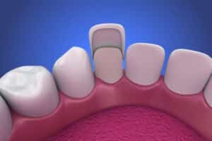 Porcelain veneers procedure Santa Ana CA