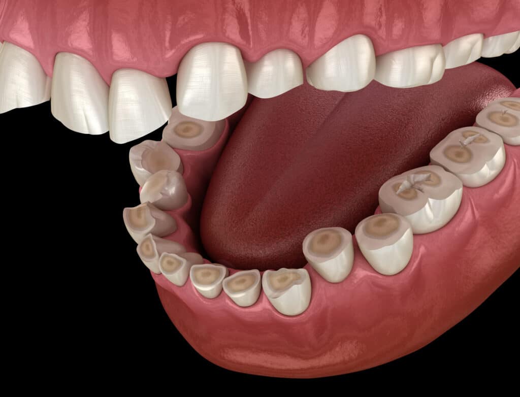 Dental attrition (Bruxism) resulting in loss of tooth tissue. Medically accurate tooth 3D illustration