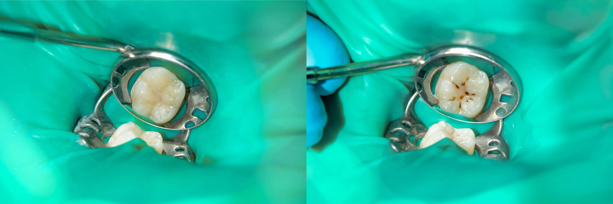 close-up of a human rotten carious tooth at the treatment stage in a dental clinic. The use of rubber dam system with latex scarves and metal clips, production of photopolymeric composite fillings