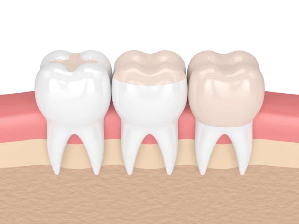3d render of teeth with inlay, onlay and crown filling in gums