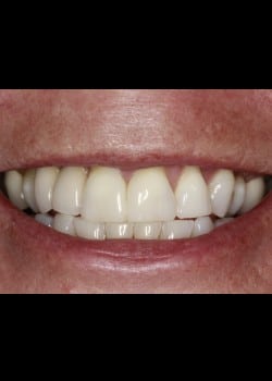 Black Triangle Closure with Dental Implants