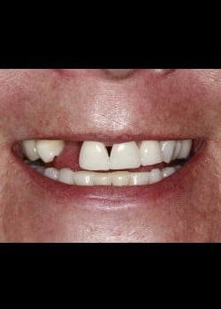 Black Triangle Closure with Dental Implants