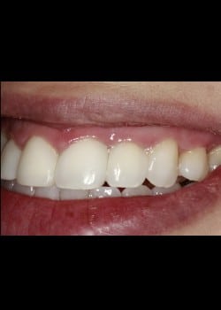 Black Triangle Resulting from Laser Gum Treatment