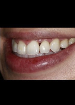Black Triangle Resulting from Laser Gum Treatment