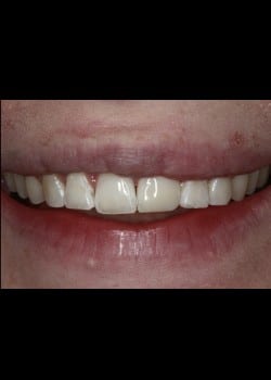 Fracture Front Tooth Repaired Using Bioclear