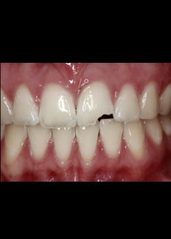 Fracture Front Tooth Repaired Using Bioclear