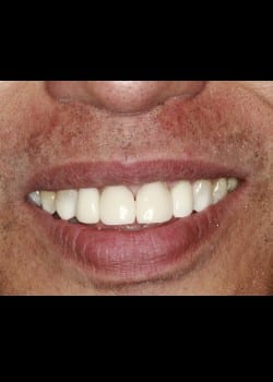 Bioclear Worn Teeth Rejuvenation 2