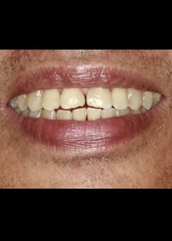 Bioclear Worn Teeth Rejuvenation 2