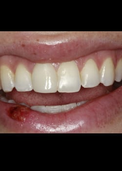 Bioclear Treatment after an Accident