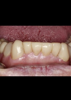 Bioclear Worn Teeth Rejuvenation