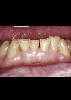 Bioclear Worn Teeth Rejuvenation