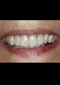 Bioclear Teeth Rejuvenation