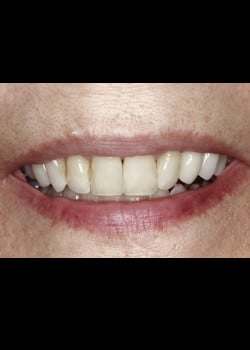 Bioclear Teeth Rejuvenation