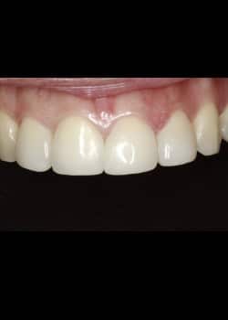 Bioclear Teeth Rejuvenation