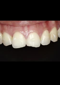Bioclear Teeth Rejuvenation