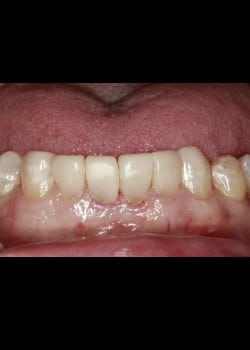 Bioclear Teeth Rejuvenation