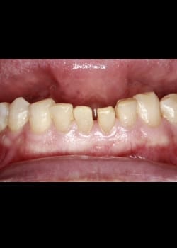 Bioclear Teeth Rejuvenation