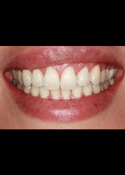 Bioclear